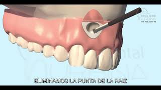 🦷Endodoncia: Apicectomia Dental🦷