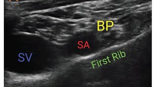 Subclavian Perivascular (SPV) Block - A Modified Parasagital Approach