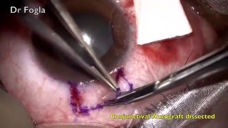 Pterygium Excision with Conjunctival Autograft