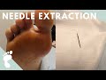 Embedded Needle Removal