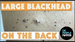 Large Blackheads on the Back