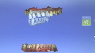 CAD CAM Full Upper Veneers - By Dr Pieter van Rooyen