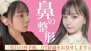 【整形】鼻を三度目の再手術！ダウンタイム経過もレポート♡