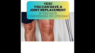 YES! You can have a Joint Replacement with Lymphedema or Lipedema!