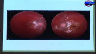 AIOCMT3 2024   GP9 topic   Dr Pooja Sinha A curious case of fever and retinitis