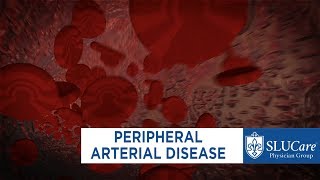 Peripheral Artery Disease \u0026 Treatment - SLUCare Vascular Surgery