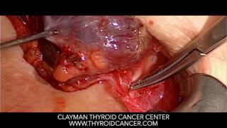 Tiny Discoveries During Thyroid Surgery Result in Big Changes