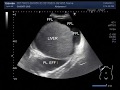 Ultrasound Video showing ascitic fluid and pleural fluid.