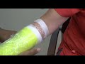 how to shower with a cast or splint