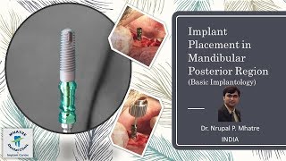 Implant placement protocol in dense bone (Posterior Mandible) by Zimmer TSV Implant