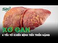 Bác Sĩ Chỉ Ra 4 Yếu Tố Khiến Bệnh Xơ Gan Tiến Triển Nặng |SKĐS