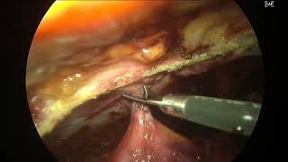 ETEP TAR for IPOM Recurrence