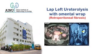 Lap Left Ureterolysis with Omental Wrap (Retroperitoneal fibrosis) | Surgical Videos