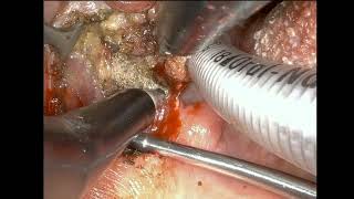 TORS Robotic resection of HPV-related tonsil and throat cancer