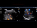 dr masciotra clinical case of intrahepatic cholelithiasis