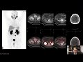 psma pet ct