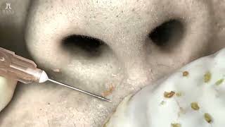 Big Cystic Acne Blackheads Extraction Blackheads \u0026 Milia, Whiteheads Removal Pimple Popping