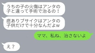 顔にアザのある私の息子を見下し、熱湯をかけようとした義姉「格好いいわw」→その後、開き直った義姉の娘が顔に大火傷を負った理由が...w