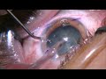 cme episode 11 full thickness lris to correct astigmatism during multifocal iol insertion