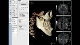 3D Ceph Superimposition