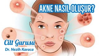 AKNE NEDİR? SİVİLCE NASIL OLUŞUR?