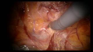 ROBOTIC RECURRENT INGUINAL HERNIA REPAIR