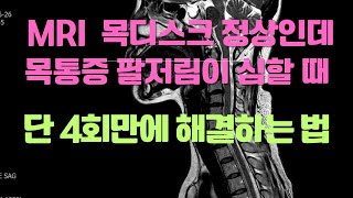 목통증 팔저림 심한데 MRI 디스크는 정상일 때 시술, 수술 안하고 낫는 방법.