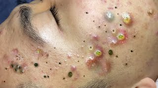 Big Cystic Acne Blackheads Extraction Blackheads \u0026 Milia, Whiteheads Removal Pimple Popping # 9223