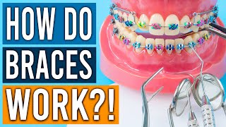 How Do Braces Work?