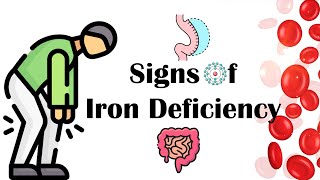 Signs Of Iron Deficiency |What Are The Signs & Symptoms Of Iron Deficiency Anemia (IDA)?