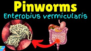 Pinworms (Threadworms): Symptoms, Causes, Treatments, Life Cycle – Enterobius vermicularis