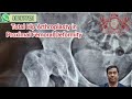 total Hip Replacement in proximal femoral deformity #Dr S.K  Sharma M.S Ortho #suryatv surya