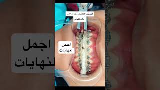 اجمل النهايات لحظة فك تقويم الأسنان #dr_abdullah_sultan_dentist #اكسبلور #اسنان #dentalcare #dentist