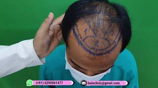 দাড়ি থেকে + মাথা থেকে গ্রাফট কালেকশন || 3100 Follicle || হেয়ার ট্রান্সপ্লান্ট || Dr. Jayanta Bain