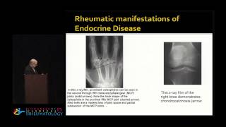 Joseph Markenson, M.D. - Rheumatic Manifestations of Endocrine Disease