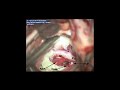 epidermoid tumor pterional transsylvian approach