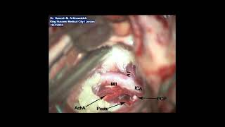 Epidermoid tumor: Pterional-Transsylvian approach