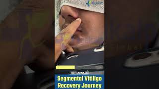 Segmental Vitiligo को Recover कैसे करें। Kayakalp Global #shorts #vitiligo #treatment