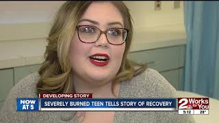 Burn survivor brings awareness to National Burn Week