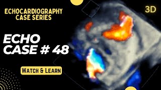 Echocardiography Case 48: Echo Spot Diagnosis Series - Learn Cardiology