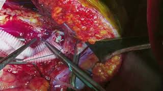 Asvide: Video clip presenting thoracoabdominal aortic aneurys repair in a patient with systemic...