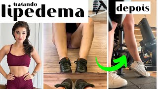 como TRATEI meu lipedema | diagnóstico, cuidados, alimentação