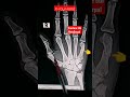 Fracture 5th metacarpal / X-ray Hand #fracture  #shorts #radiography