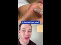 crazy way to remove blackheads jet peel demo 208skindoc