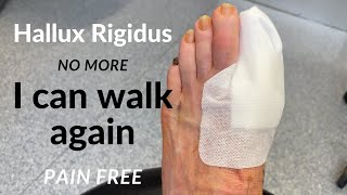 Hallux Rigidus No More