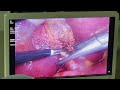 laparoscopic cholecystectomy by dr chathuranga kappetiyagama gi surgeon.