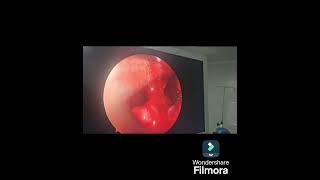 nasal polyp and endoscopic sinus surgery