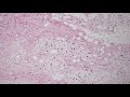 pleomorphic lipoma pathology mini tutorial