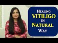 Healing Vitiligo Naturally | What Causes White Spots| How to Clear White Spots on the Skin Naturally