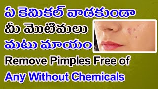 ఏ కెమికల్ వాడకుండా మీ మొటిమలు మటు మాయం | Remove Pimples Free of any Without Chemicals